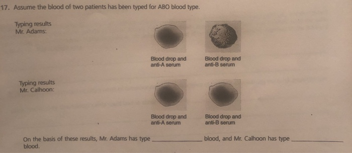 17. Assume the blood of two patients has been typed for ABO blood type. Typing results Mr. Adams: Blood drop and anti-A serum